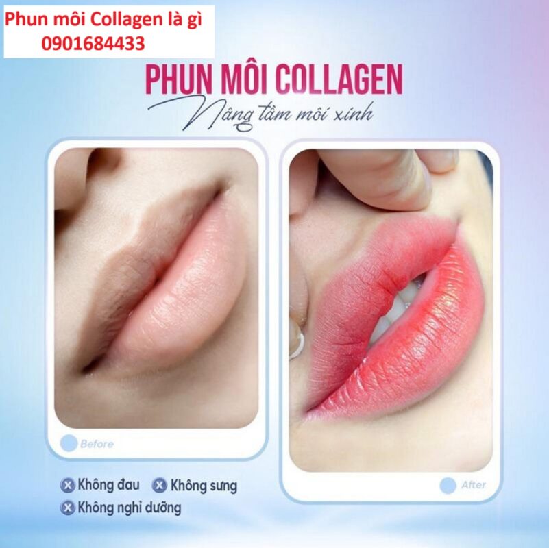 Phun Môi Collagen Là Gì? Hotline tư vấn: 0901684433