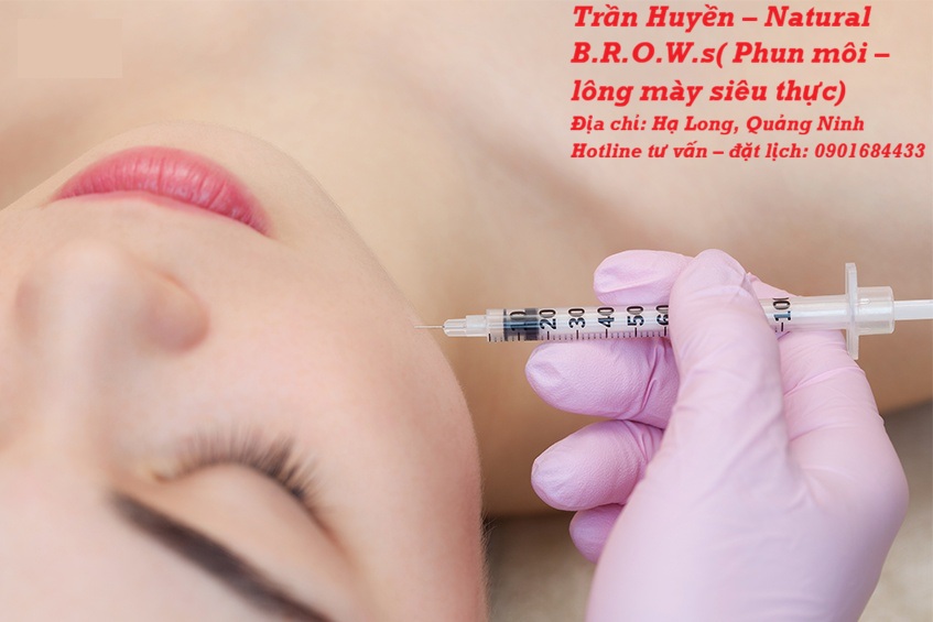 Có nên tiêm Filler không - Giải đáp từ chuyên gia